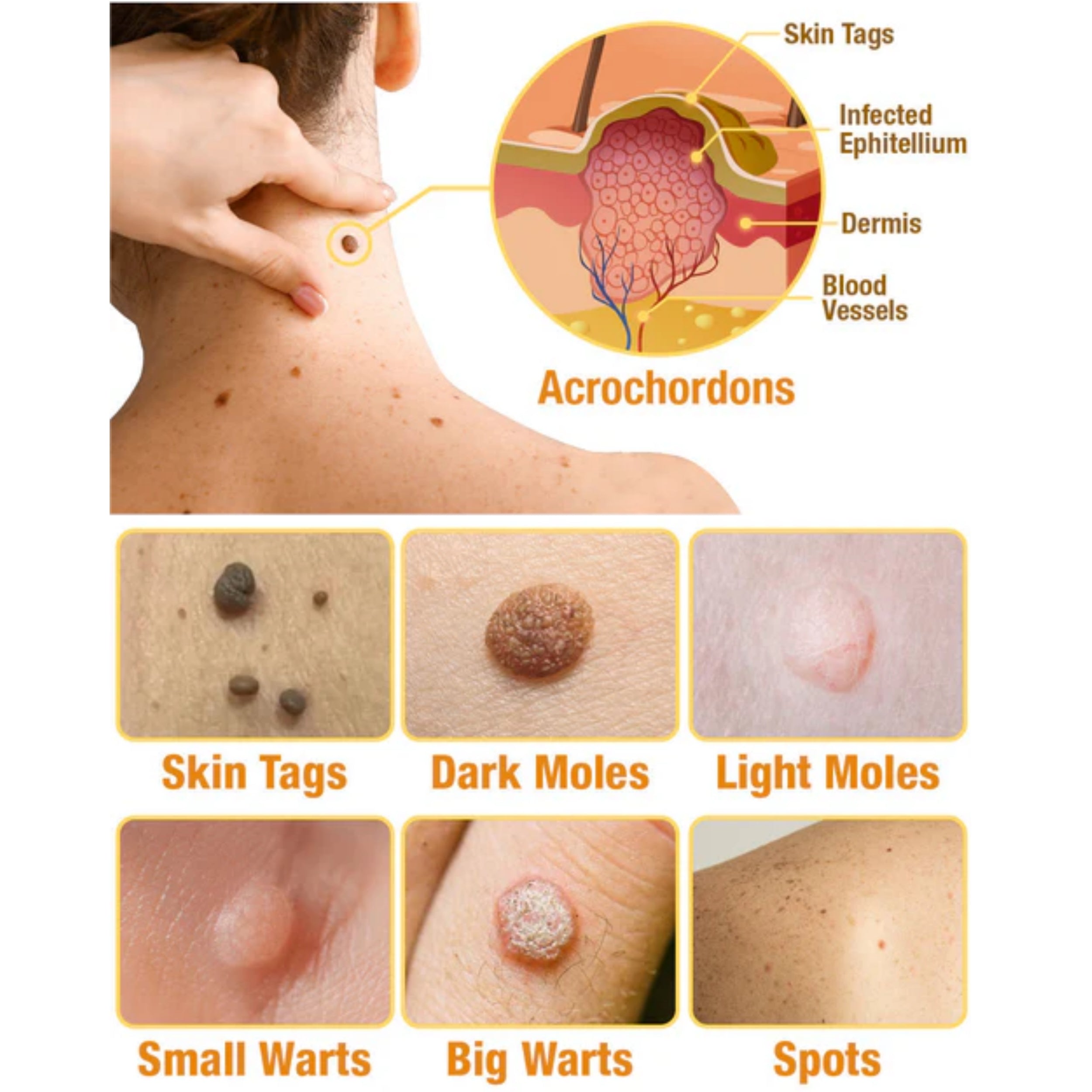 TagAway | Effective removal of warts and skin growths