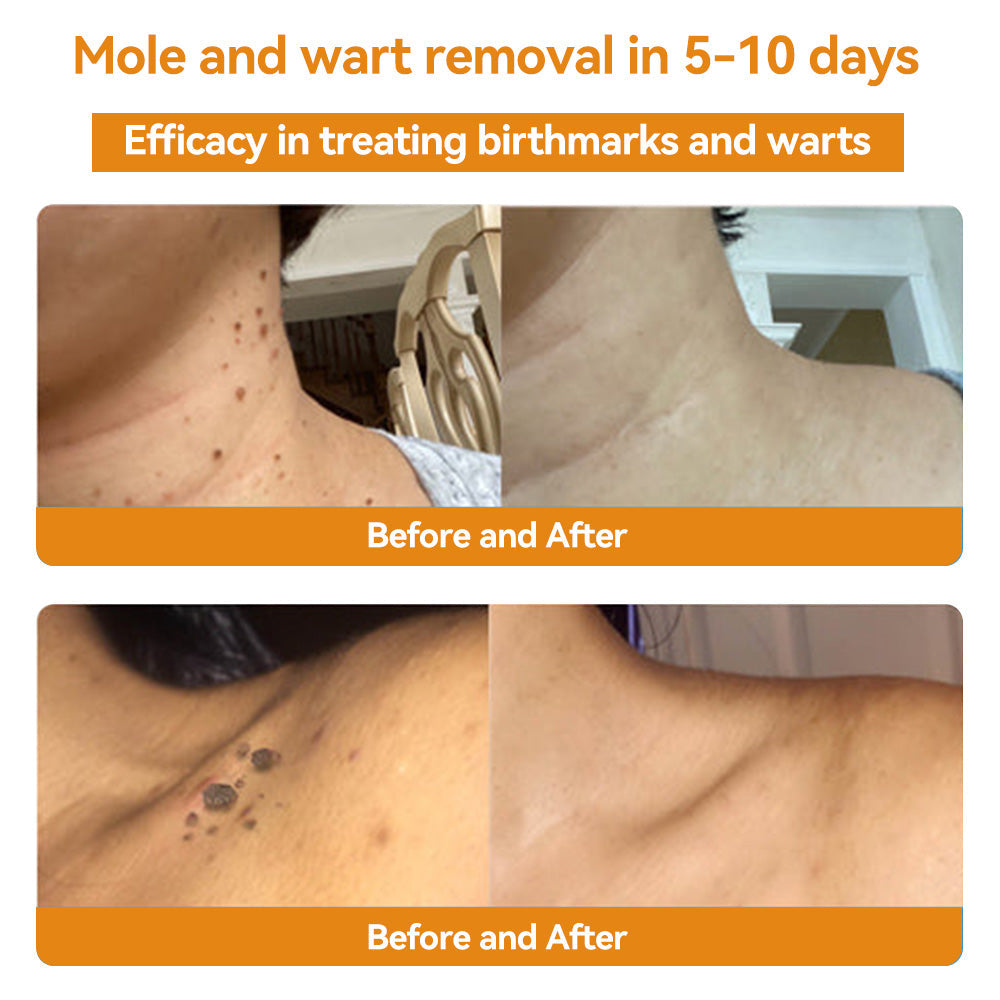 TagAway | Effective removal of warts and skin growths