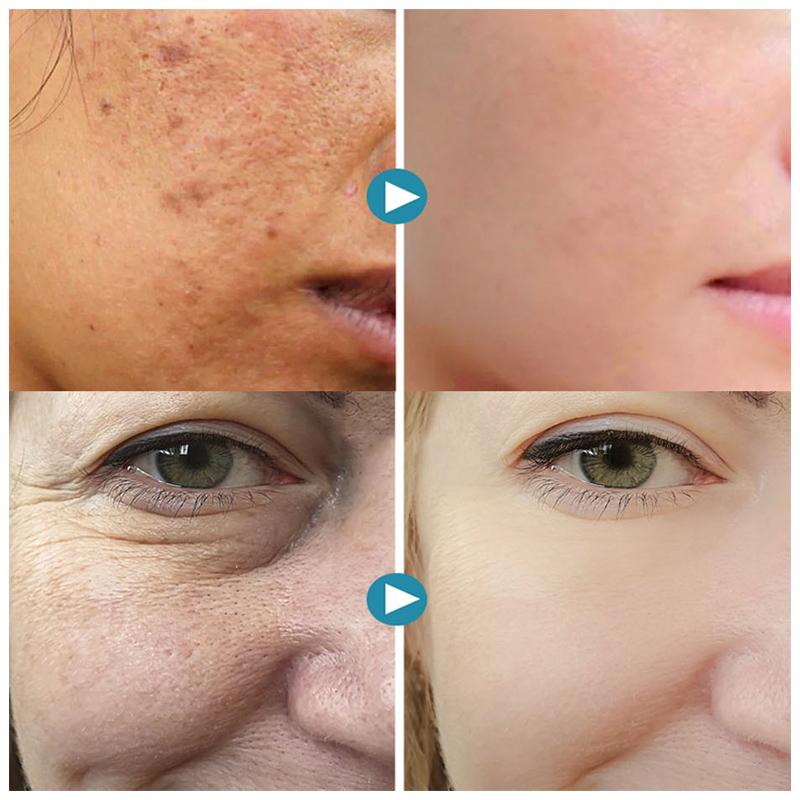1+1 FREE | PoreGel™ - Be confident in your own skin again!