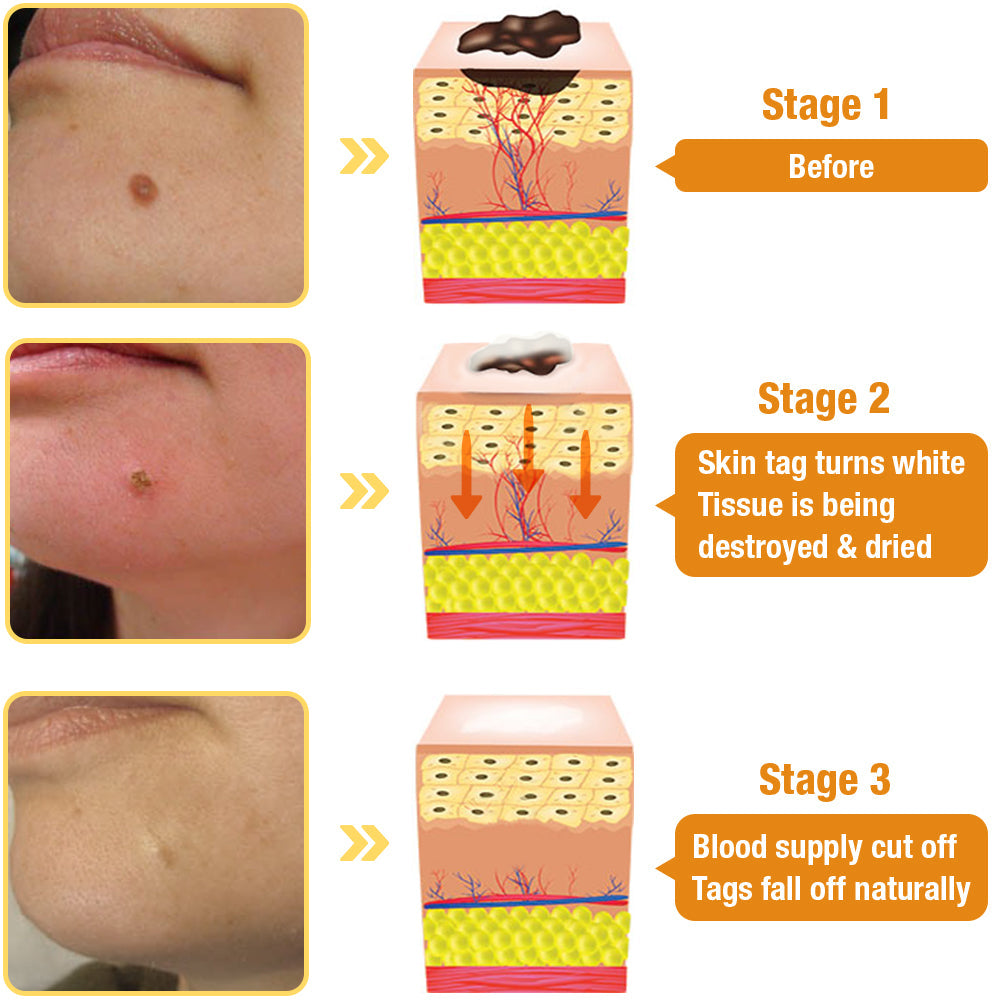 TagAway | Effective removal of warts and skin growths
