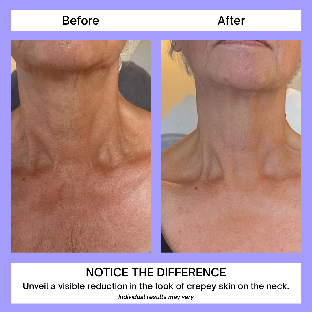UltraFirm | Experience the magic of Advanced Neck Lifting and Firming Cream